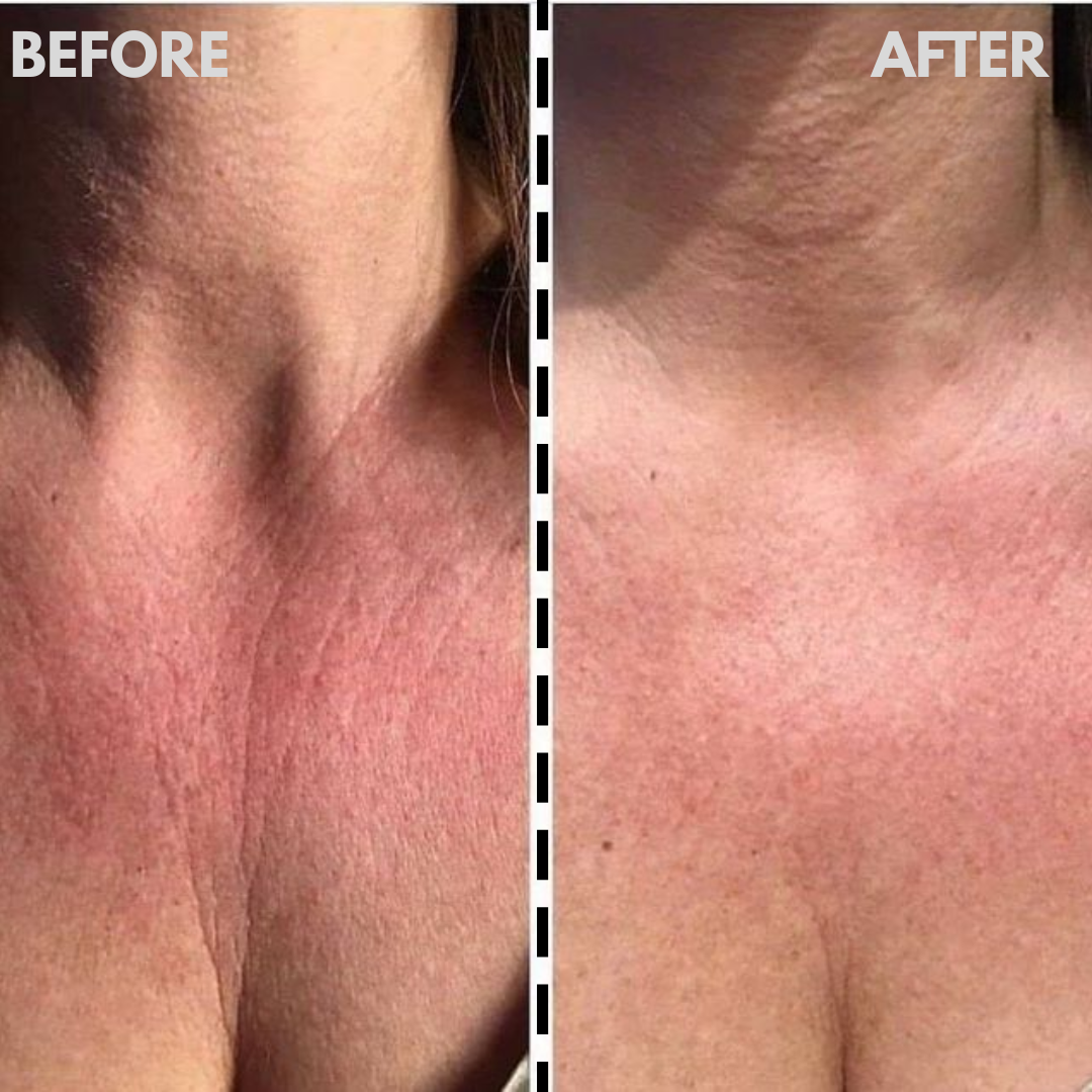 AESTHERA™ Pro-Grade LED Neck & Décolleté Mask
