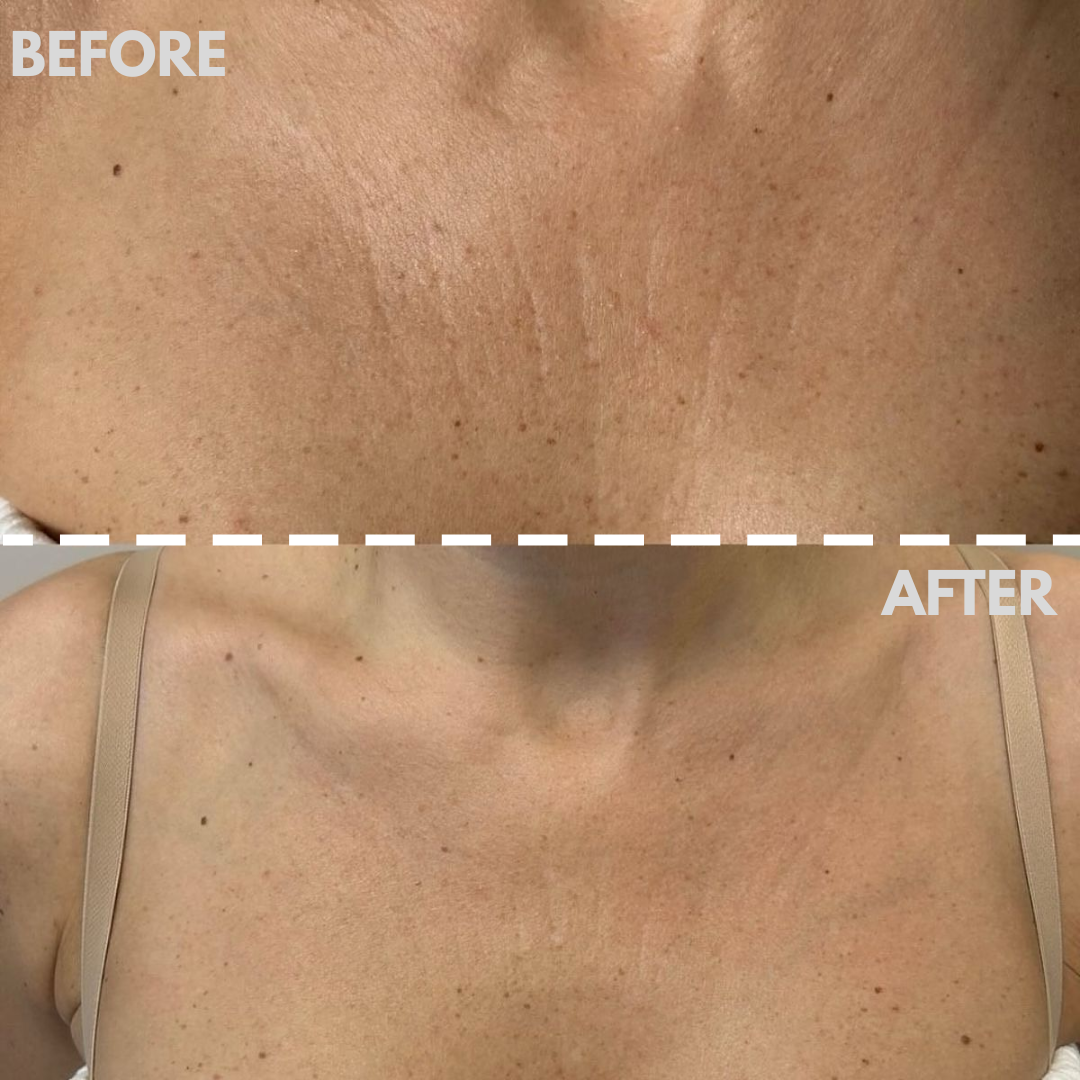 AESTHERA™ Pro-Grade LED Neck & Décolleté Mask
