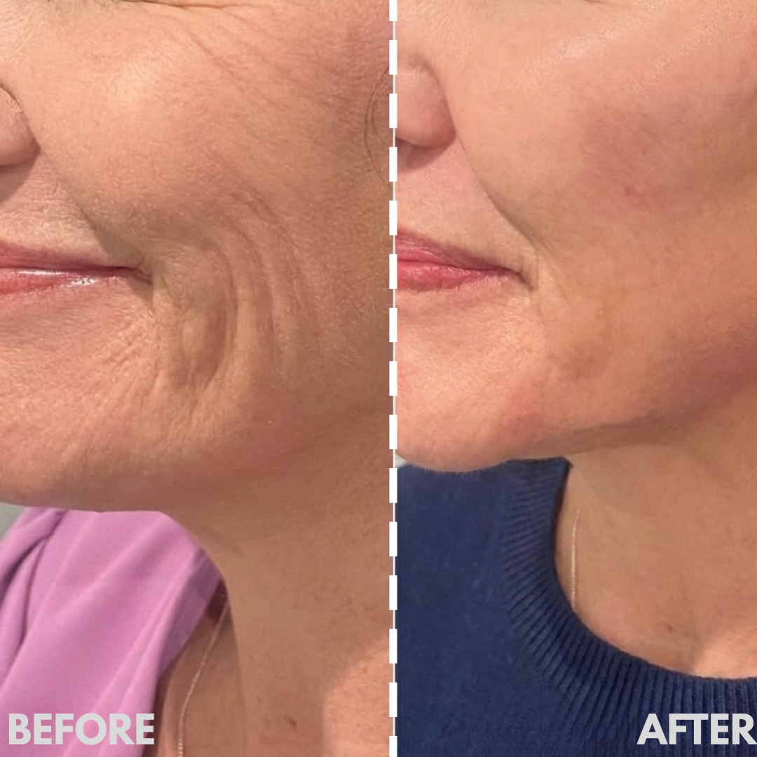 AESTHERA™ V-Sculpt Pro EMS
