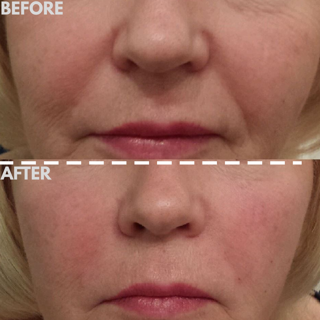 AESTHERA™ V-Sculpt Pro EMS