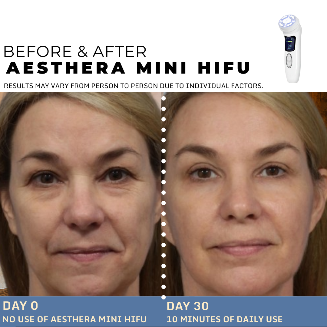 AESTHERA™ 4th GEN MINI HIFU