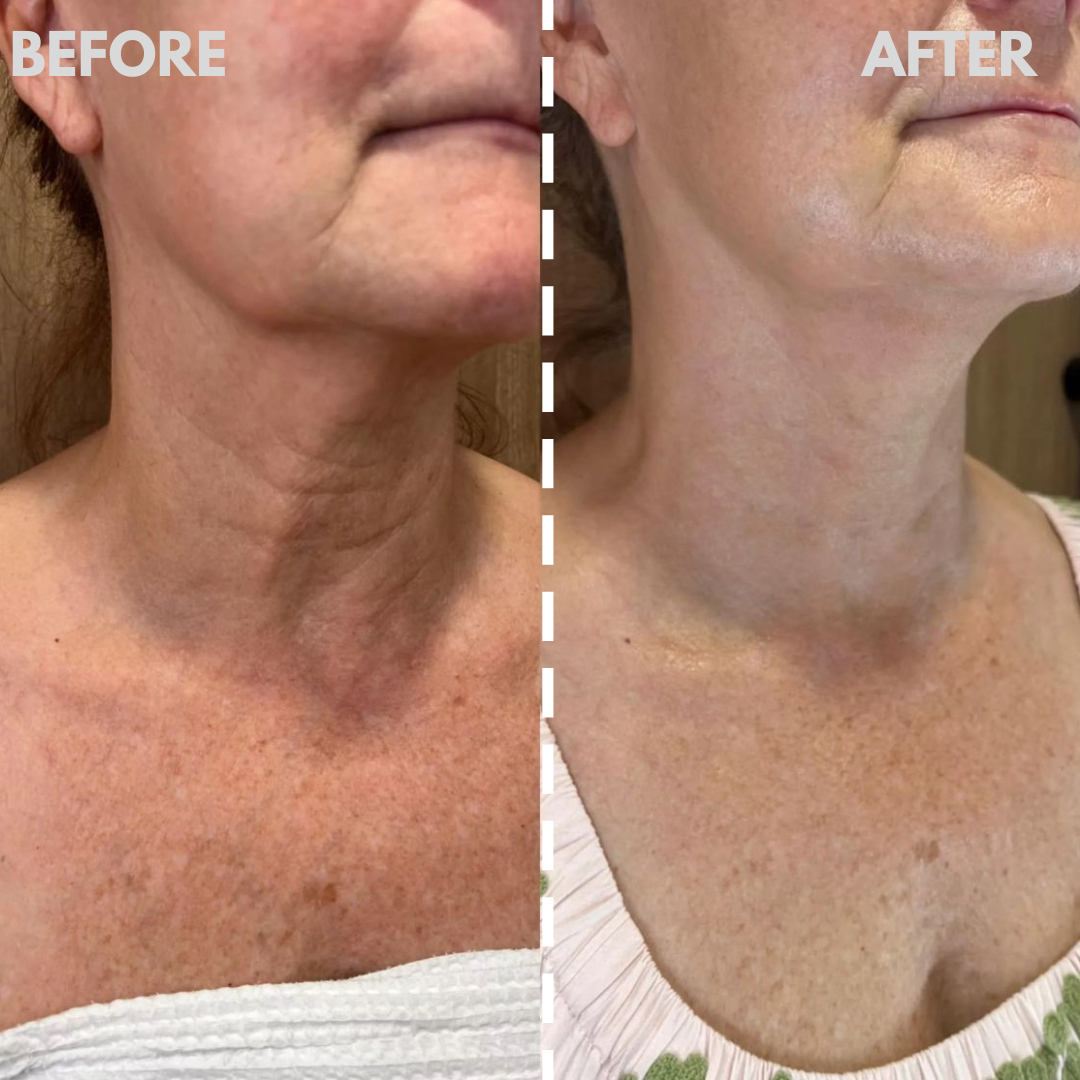 AESTHERA™ Pro-Grade LED Neck & Décolleté Mask